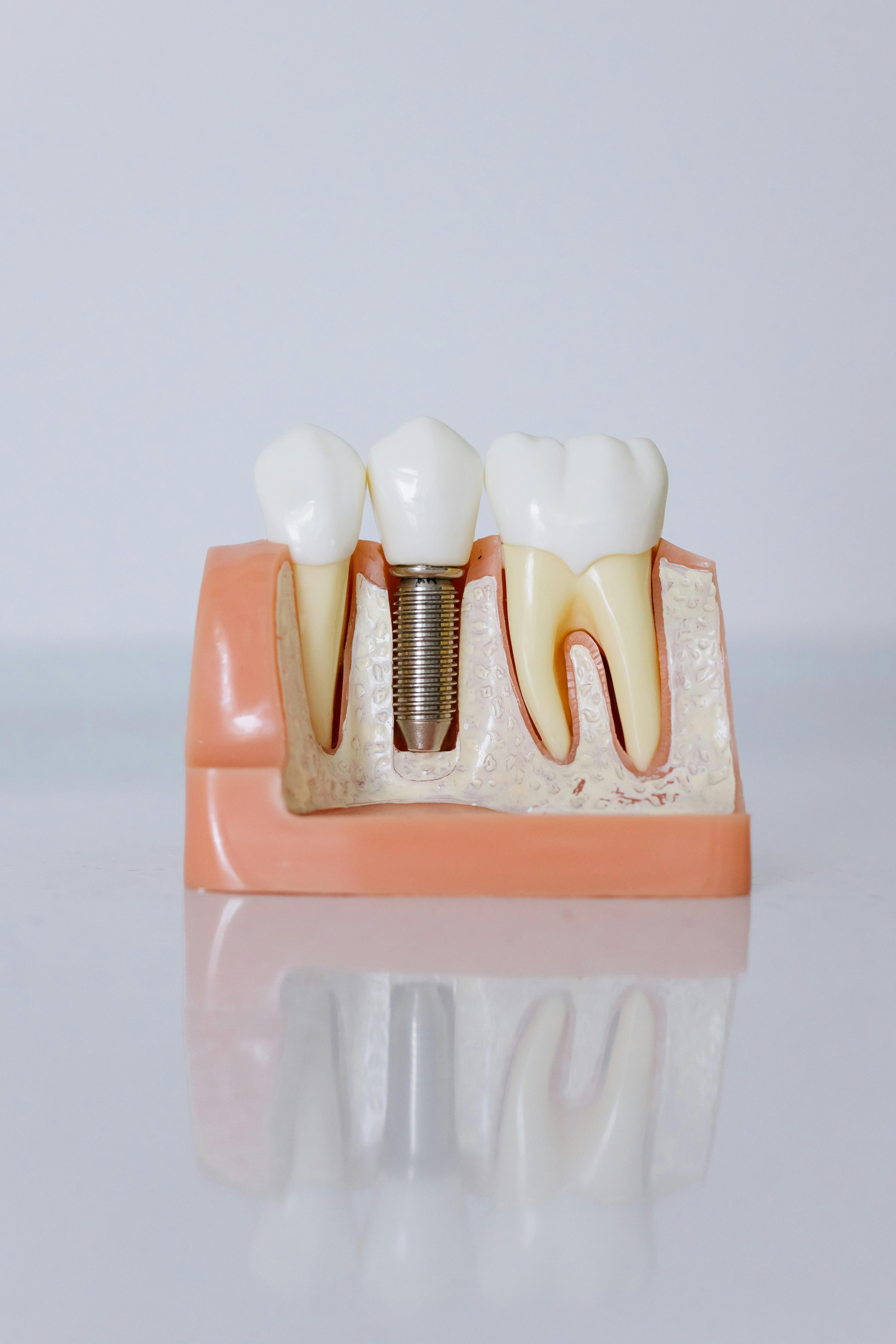 Dental implants guide at MDRN Dental Studio McKinney TX