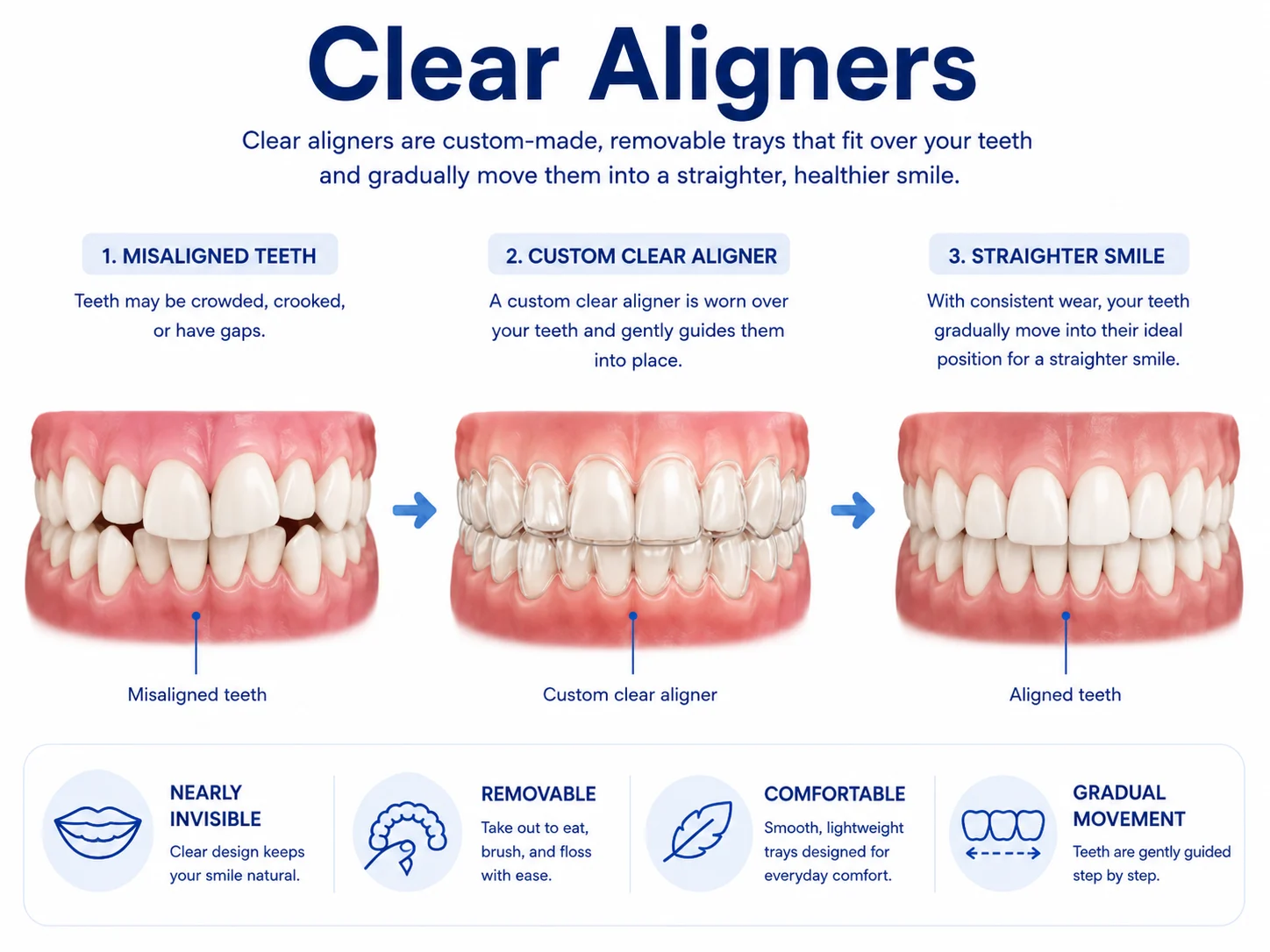 Infographic explaining clear aligner treatment from misaligned teeth to custom aligner to straighter smile