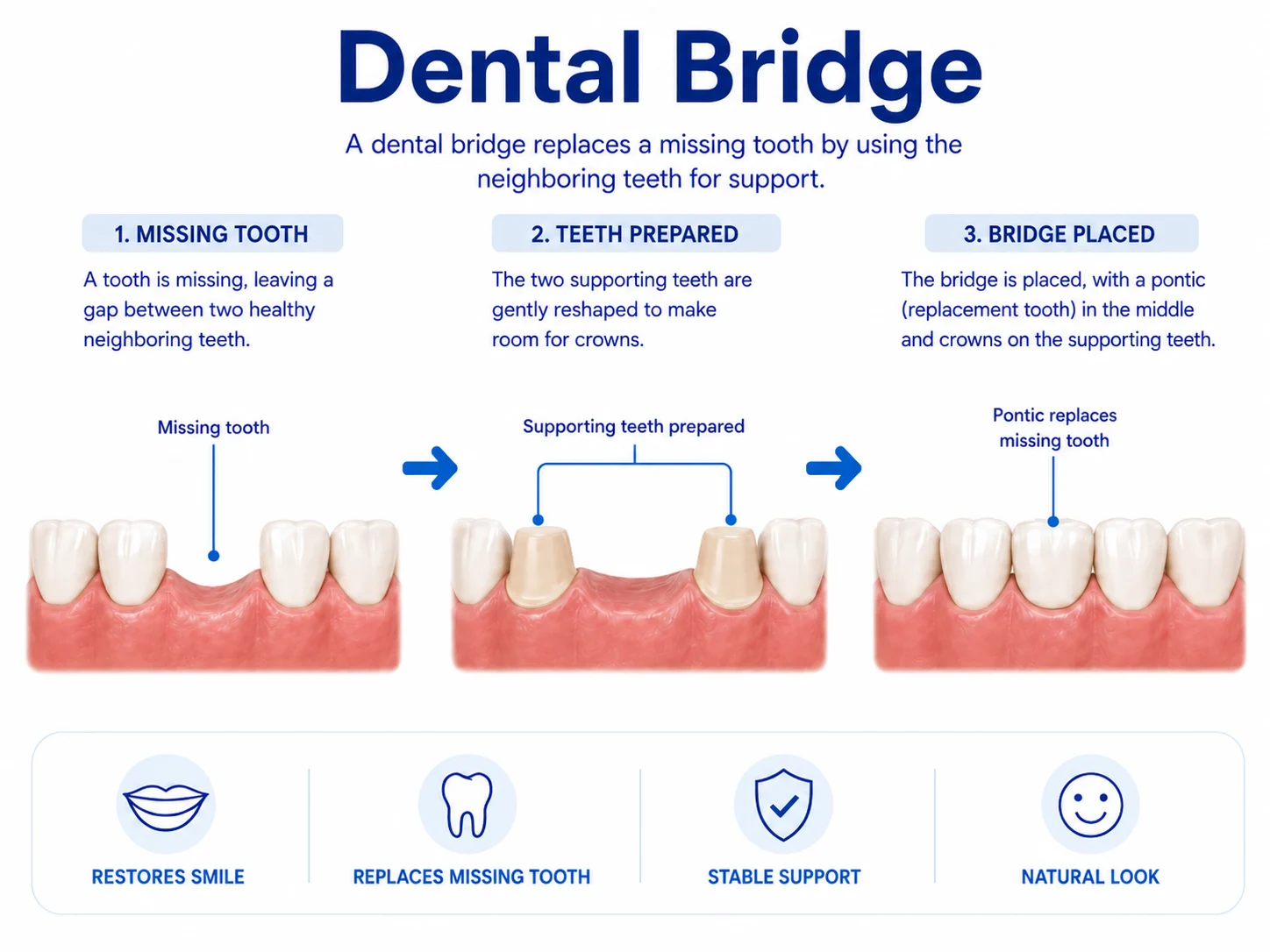 Infographic explaining dental bridge treatment from missing tooth to prepared supporting teeth to final bridge