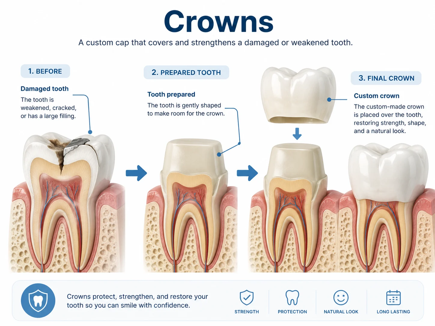 Infographic explaining dental crown treatment from damaged tooth to prepared tooth to final crown