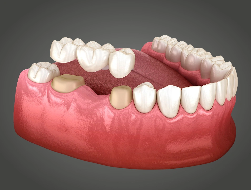 Digital impression for dental crown at MDRN Dental Studio