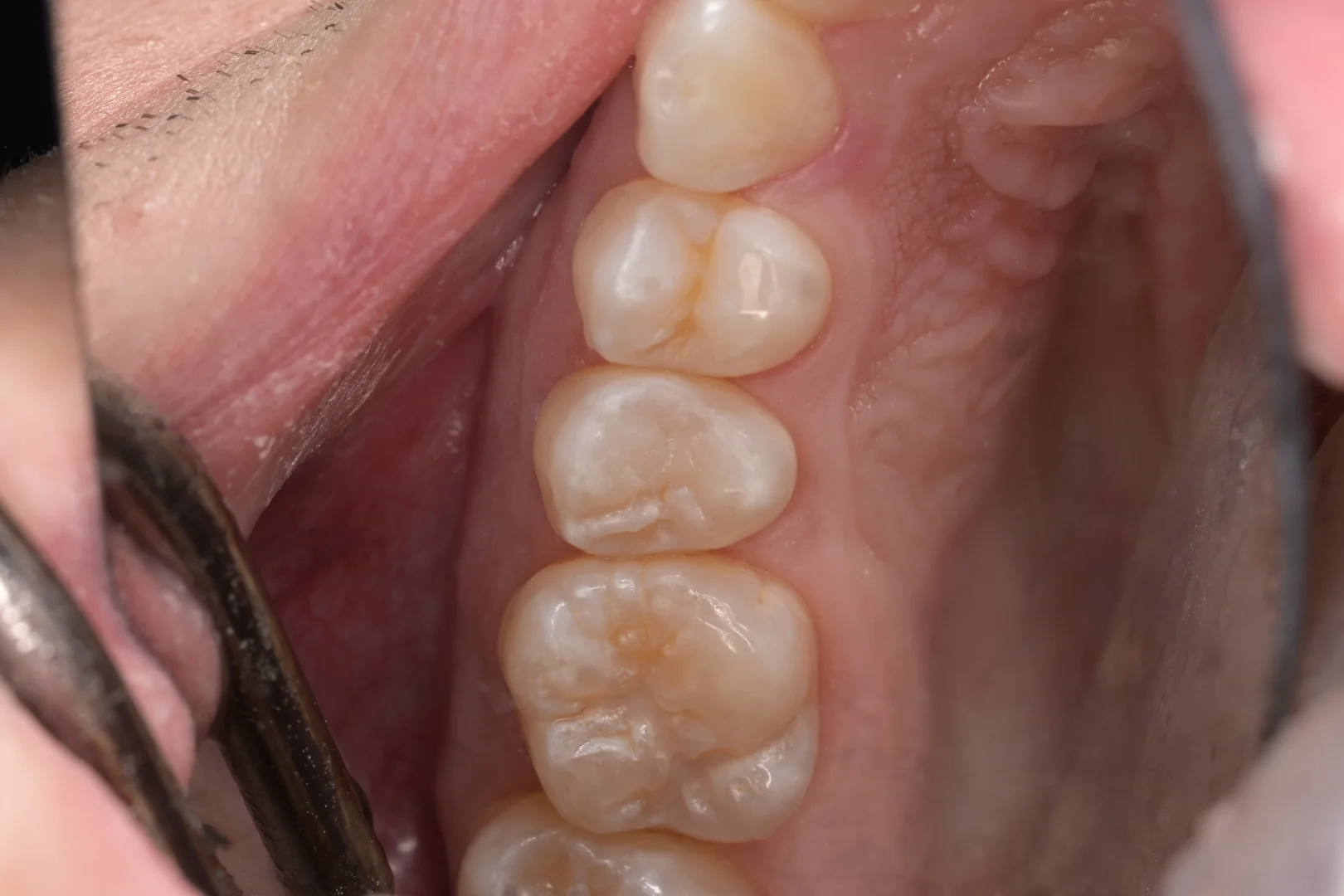 After tooth-colored composite filling treatment for a back tooth at MDRN Dental Studio