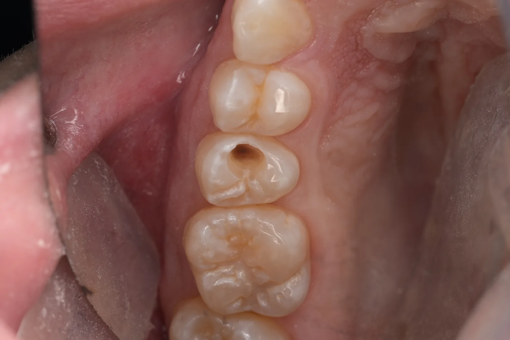 Before composite filling treatment for a back tooth cavity at MDRN Dental Studio