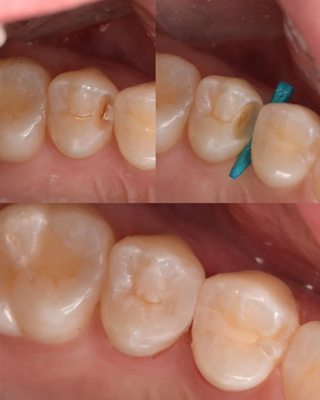 Composite filling treatment collage from an actual MDRN Dental Studio patient