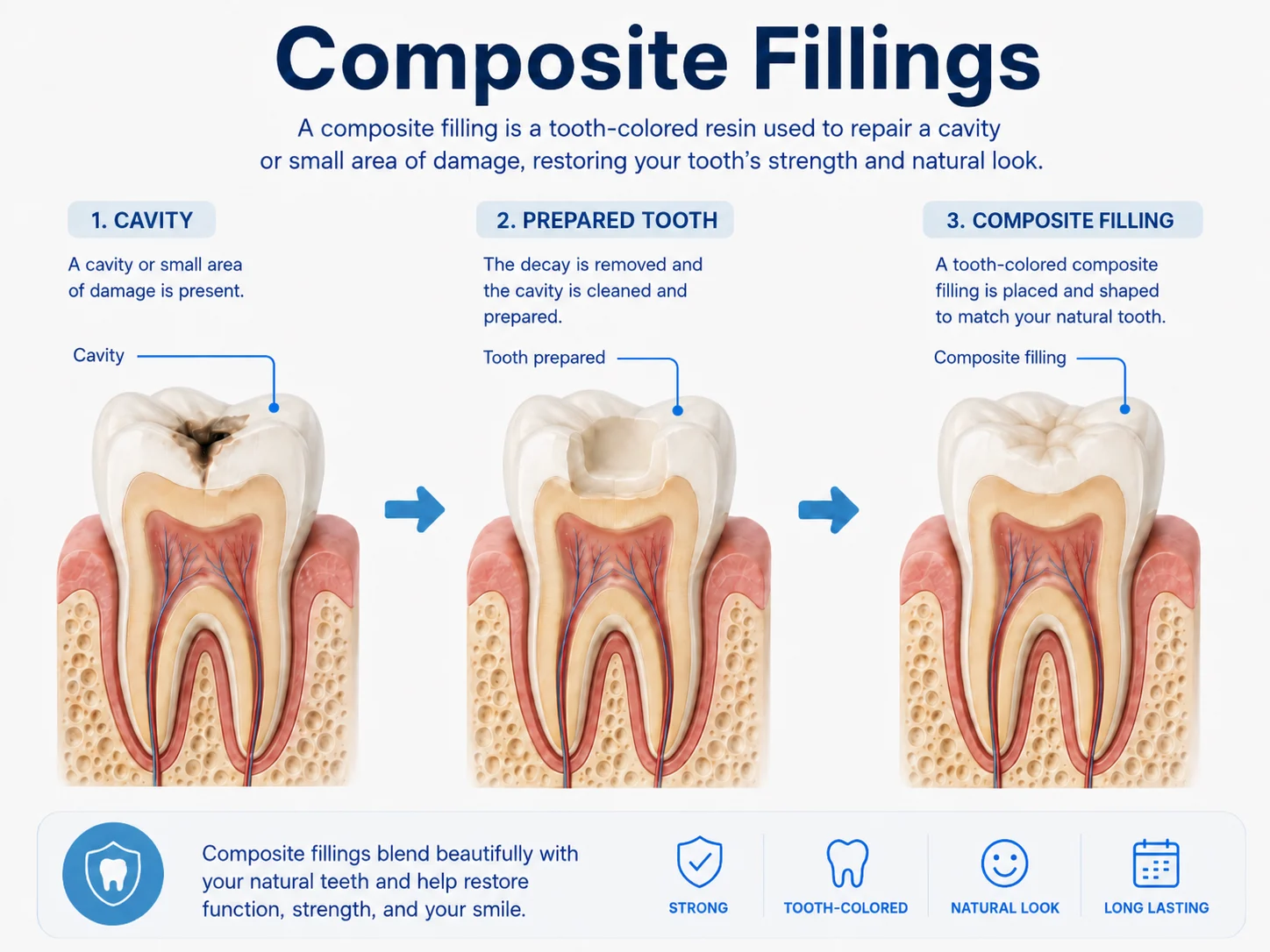 Infographic explaining composite filling treatment from cavity to prepared tooth to tooth-colored filling
