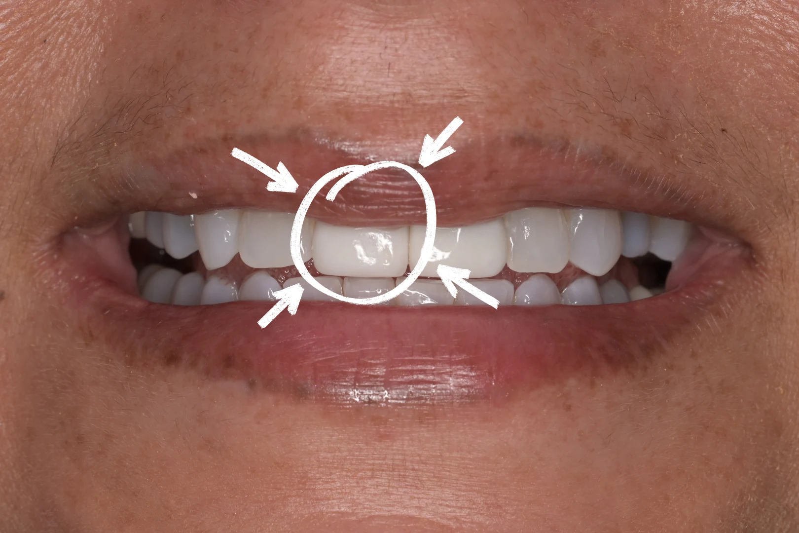 Before photo of fractured upper front tooth number 8 before extraction at MDRN Dental Studio