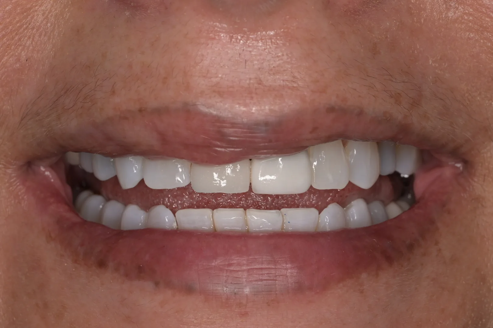 Immediate implant for tooth number 8 with custom temporary crown right after surgery