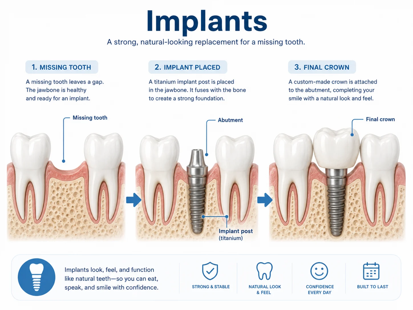 Infographic explaining dental implants from missing tooth to implant post to final crown