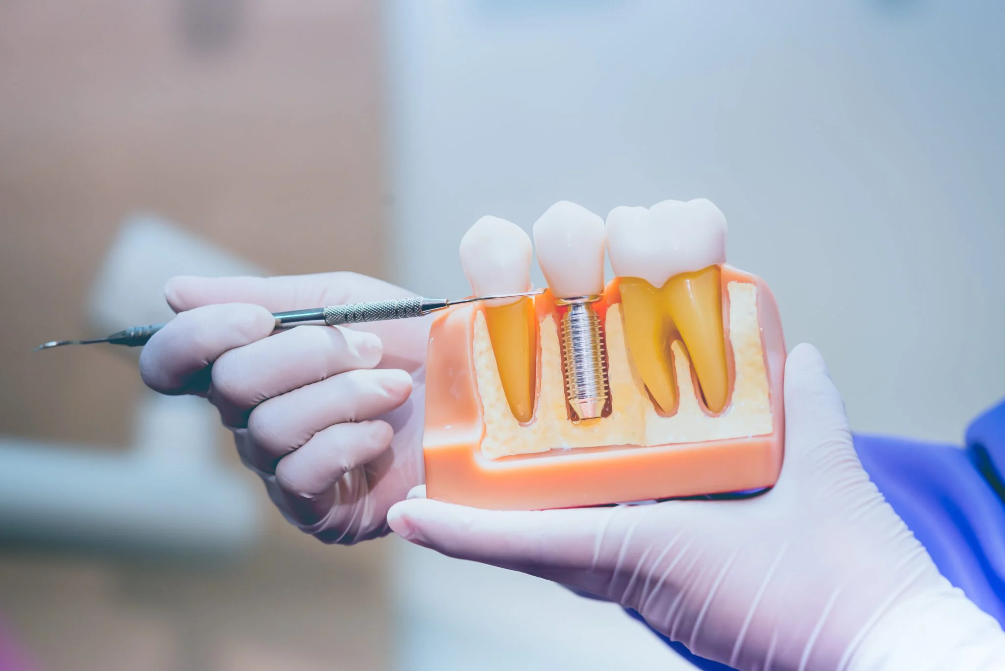 Patient smiling confidently after receiving dental implants at MDRN Dental Studio in McKinney, TX