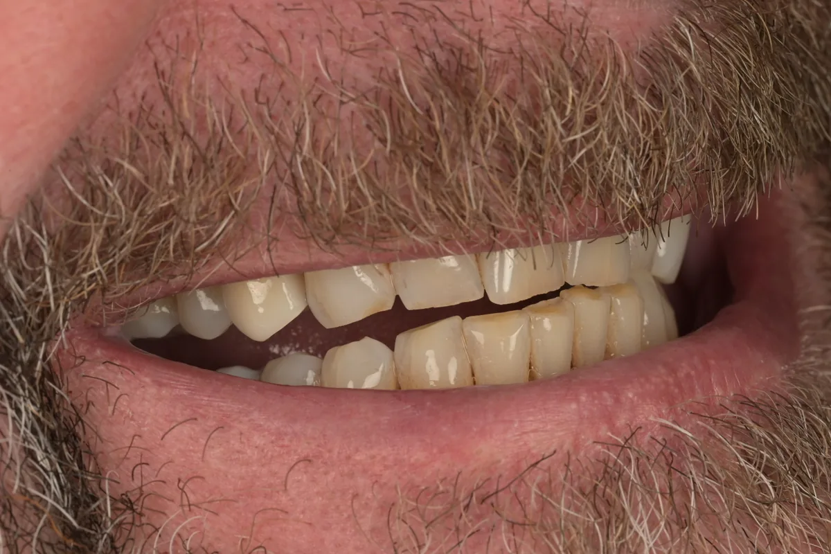 After dental implant crown replacement for upper premolar tooth number 5 at MDRN Dental Studio