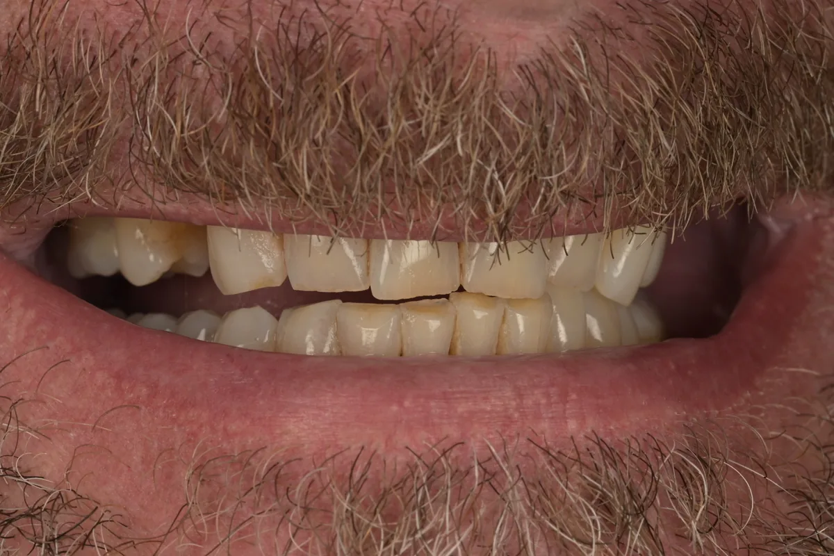 Before dental implant replacement for upper premolar tooth number 5 at MDRN Dental Studio