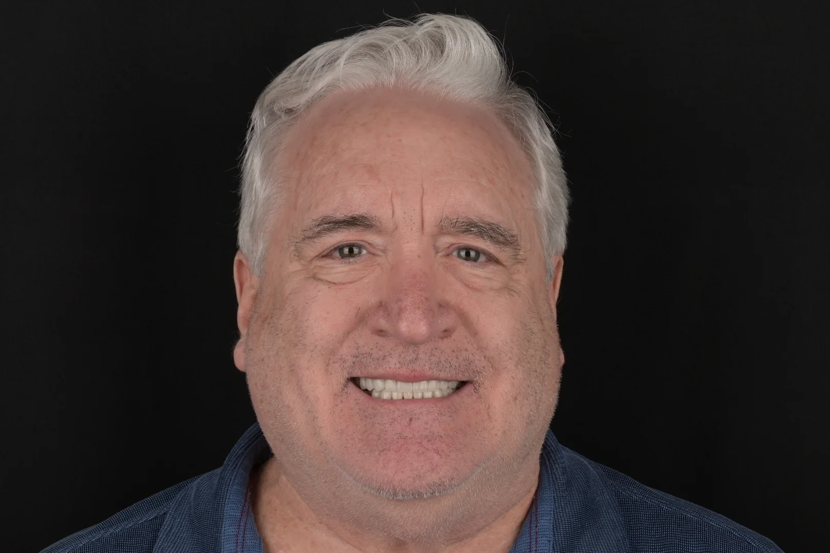 Final smile portrait after full mouth rehabilitation, actual MDRN Dental Studio patient