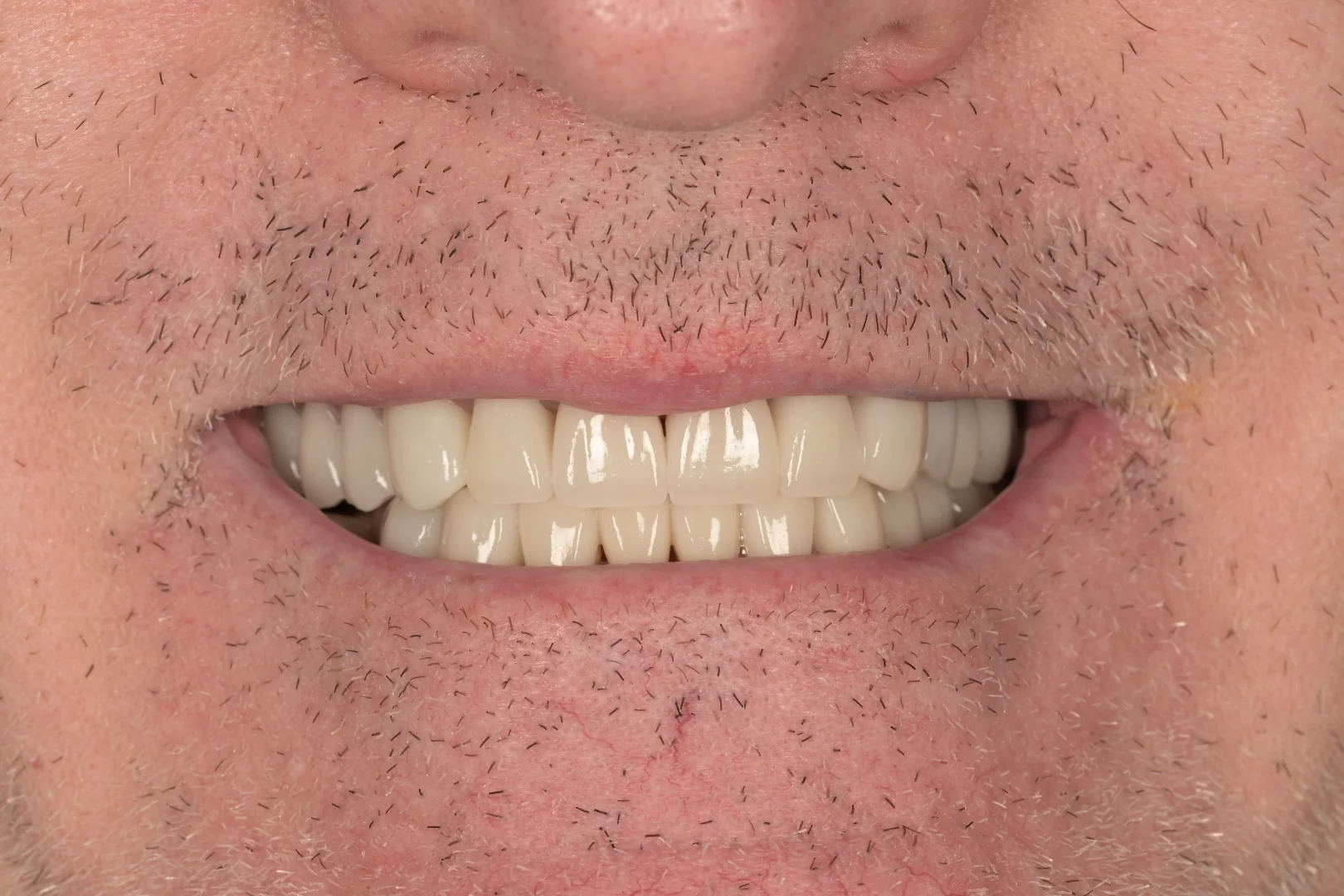 After full mouth rehabilitation treatment, actual MDRN Dental Studio patient smile photo