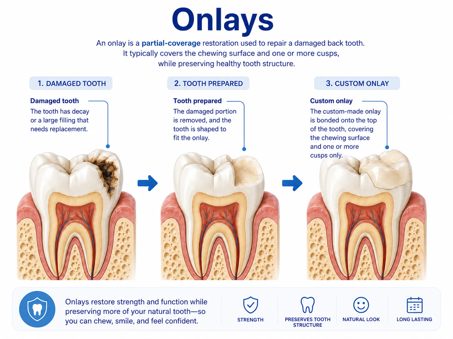 Infographic explaining dental onlay treatment from damaged tooth to prepared tooth to custom onlay