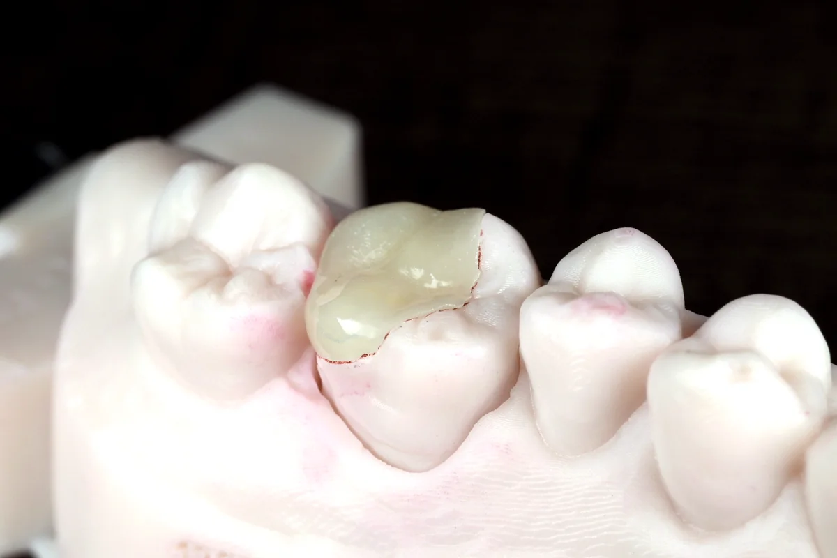 De-identified MDRN Dental Studio onlay example seated on a back tooth model