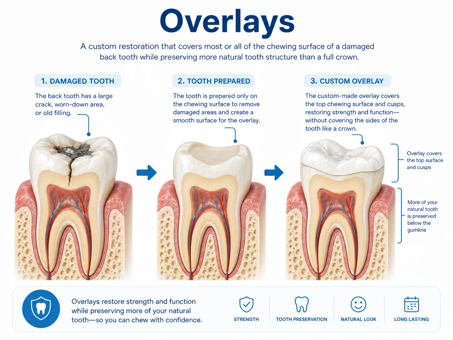 Infographic explaining dental overlay treatment from damaged tooth to prepared tooth to custom overlay
