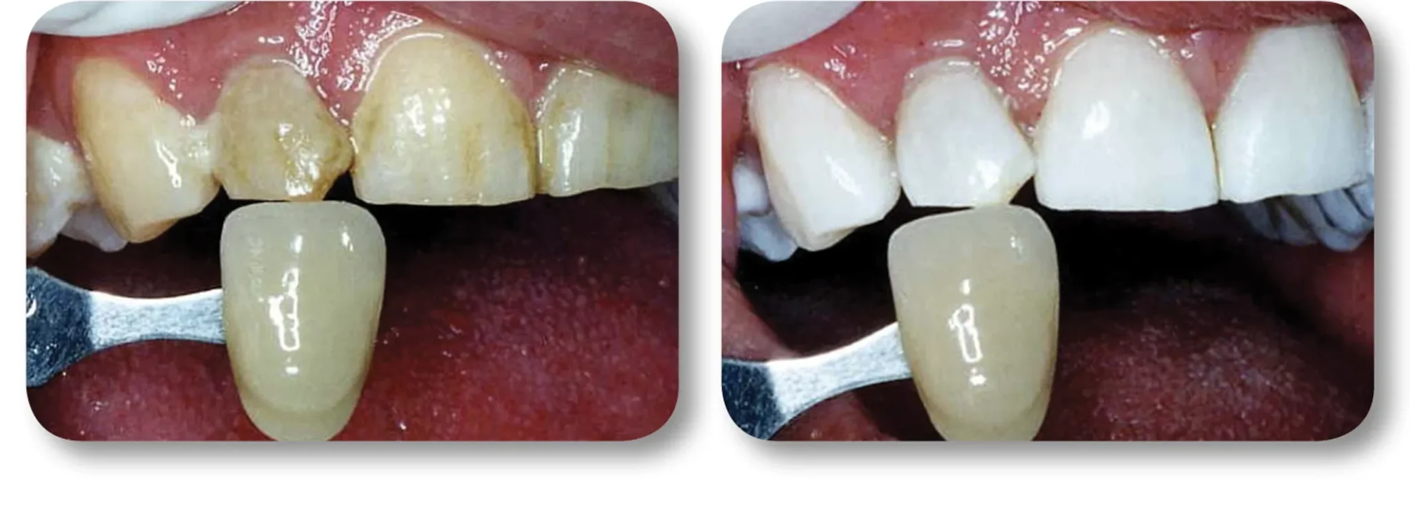 KöR whitening before and after result 2 at MDRN Dental Studio