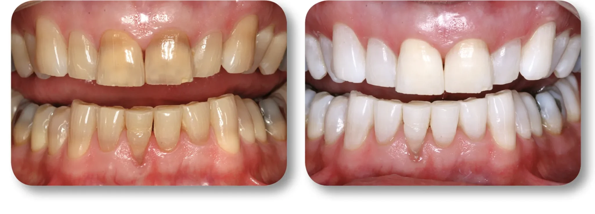 KöR whitening before and after result 3 at MDRN Dental Studio