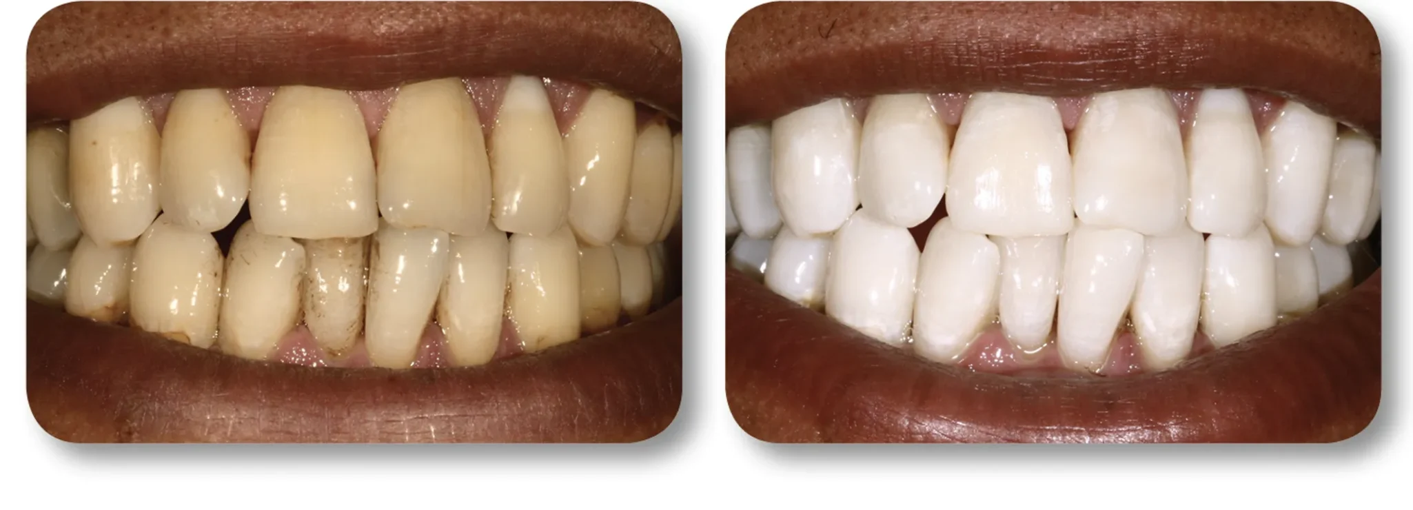 KöR whitening before and after result 4 at MDRN Dental Studio