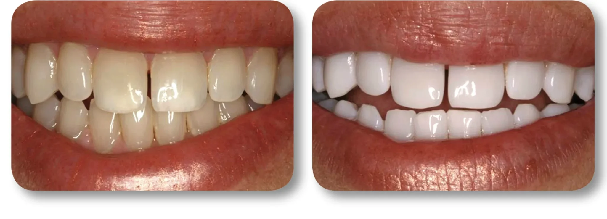 KöR whitening before and after result 5 at MDRN Dental Studio