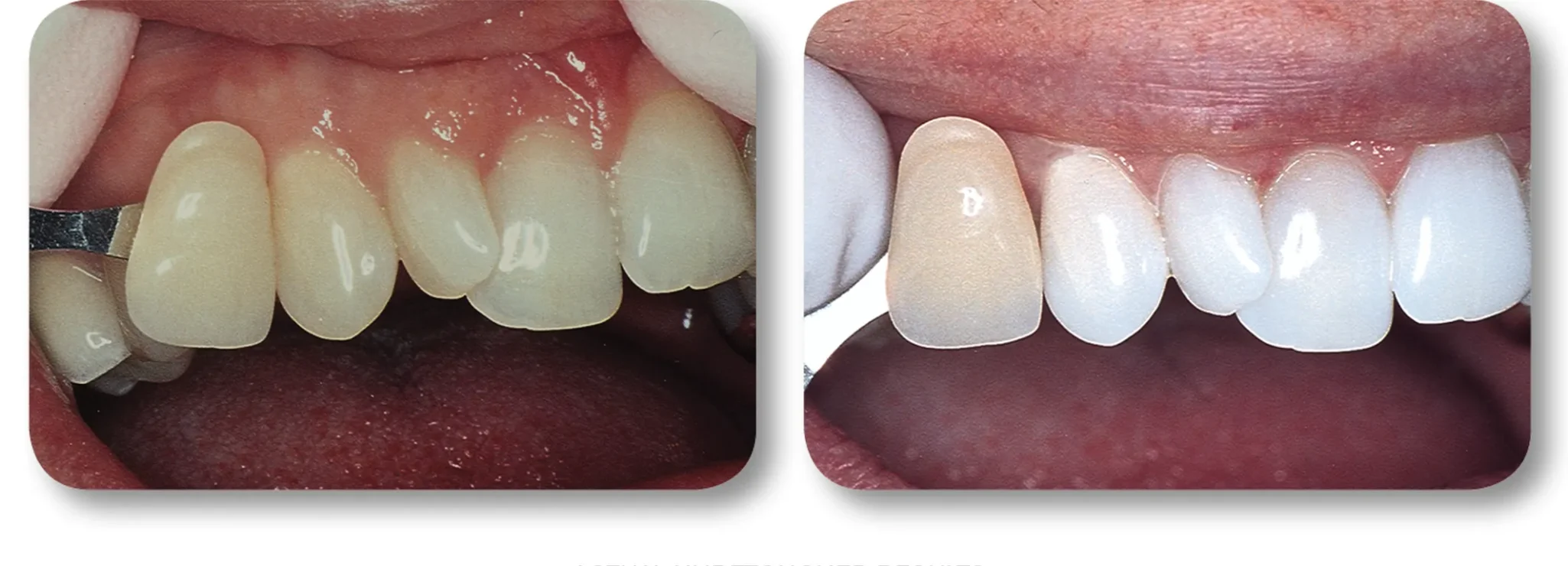 KöR whitening before and after result 6 at MDRN Dental Studio