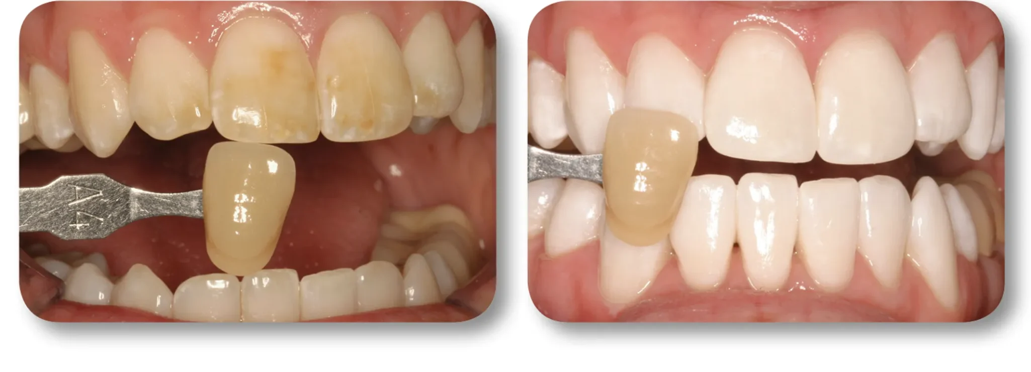 KöR whitening before and after result 1 at MDRN Dental Studio