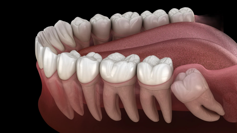 Why wisdom teeth cause problems illustrated at MDRN Dental Studio