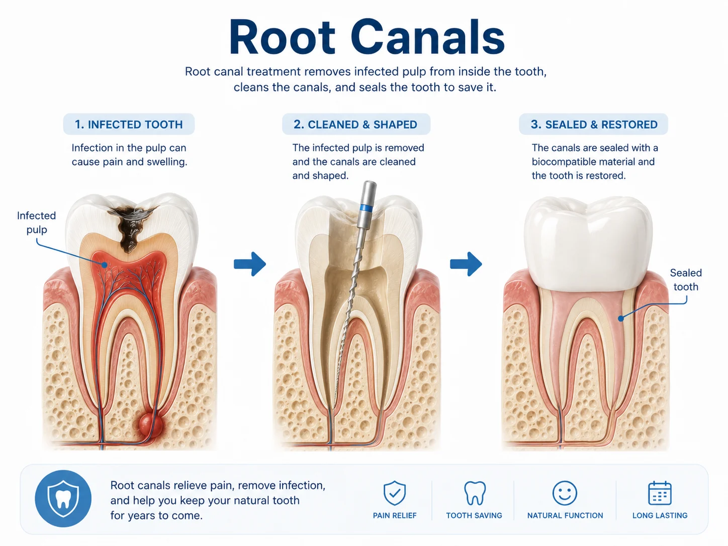 Infographic explaining root canal treatment from infected tooth to cleaned canals to sealed and restored tooth